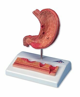 3B Scientific K17 Stomach with Ulcers Model, 5.5