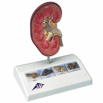 3B Scientific K29 Kidney Stone Model, 5.5